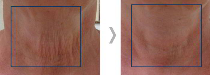 Efekt ClearLift 1