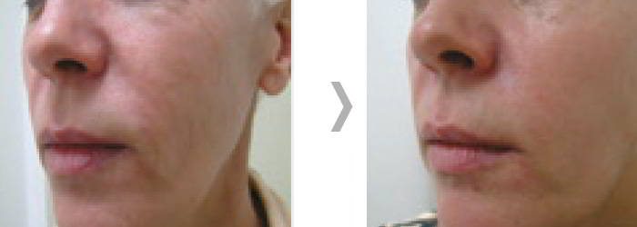 Efekt ClearLift 3