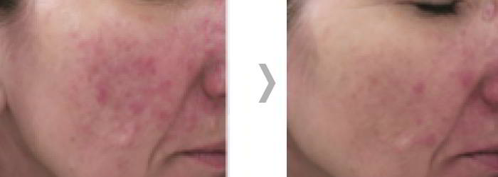 Efekt ClearLift 4
