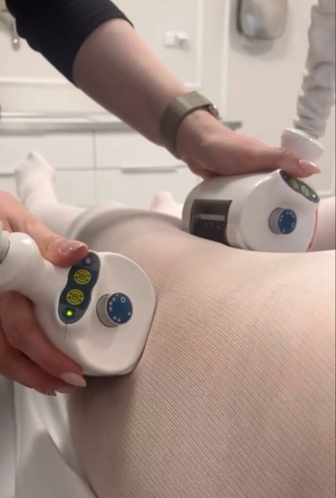 Icoone Laser Rezultaty