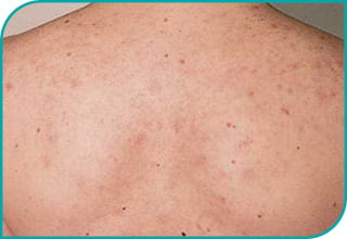 acne przed po 8